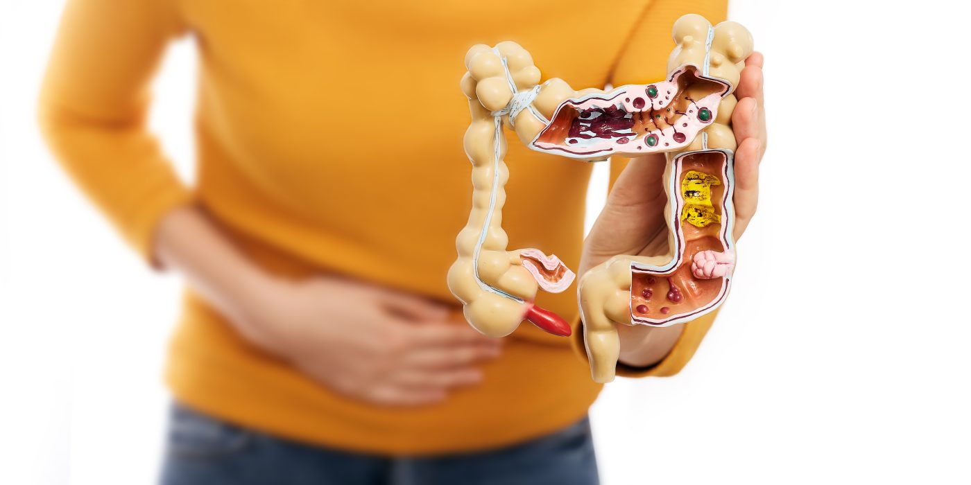 Best Cannabis Strains for Crohn’s Disease: 2025 Guide